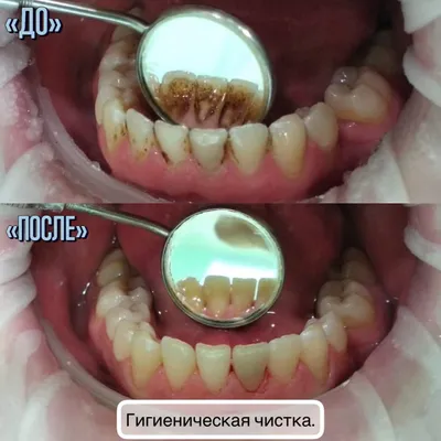 Гигиеническая чистка