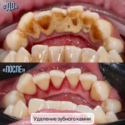 Удаление зубного камня