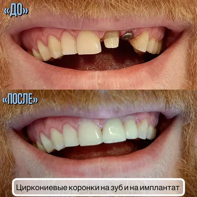 Циркониевые коронки на зуб и имплантат