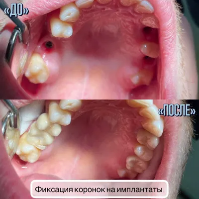 Фиксация коронок на имплантах