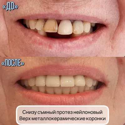 Съёмный протез и металлокерамика