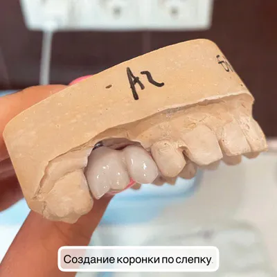 Создание коронки по слепку