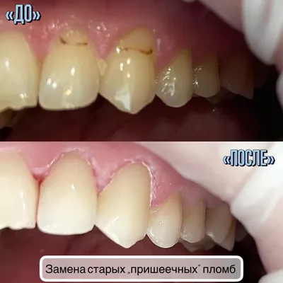 Замена пришеечных пломб